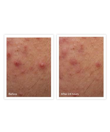 Shop Murad Rapid Relief Acne Spot Treatment - 0.5 oz/ 15 mL Online - Best Price & International Shipping - Buy Online on GoSupps.com