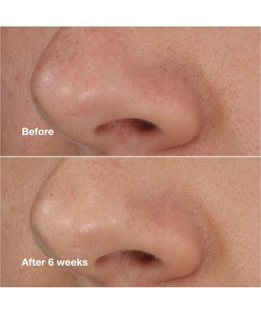 Shop CLINIQUE Blackhead Solutions Self-heating Blackhead Extractor - 0.68 oz/ 20 mL Online - Best Price & International Shipping - Buy Online on GoSupps.com