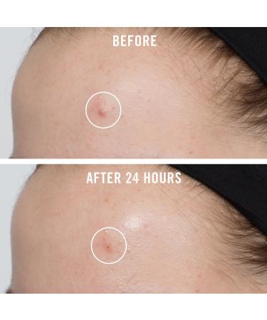 Shop First Aid Beauty FAB Pharma BHA Acne Spot Treatment Gel 2% Salicylic Acid Online - Best Price & International Shipping - Buy Online on GoSupps.com