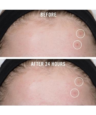 Shop First Aid Beauty FAB Pharma BHA Acne Spot Treatment Gel 2% Salicylic Acid Online - Best Price & International Shipping - Buy Online on GoSupps.com