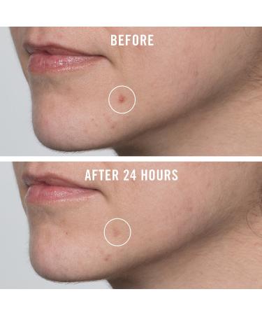 Shop First Aid Beauty FAB Pharma BHA Acne Spot Treatment Gel 2% Salicylic Acid Online - Best Price & International Shipping - Buy Online on GoSupps.com