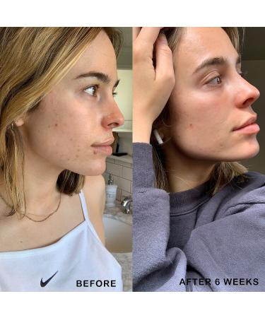 Shop Dermalogica Retinol Acne Clearing Oil - 1 oz/ 30 mL Online - Best Price & International Shipping - Buy Online on GoSupps.com