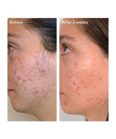 Shop Murad AHA/BHA/Retinoid Daily Clarifying Peel - 3.2 oz/ 95 mL Online - Best Price & International Shipping - Buy Online on GoSupps.com