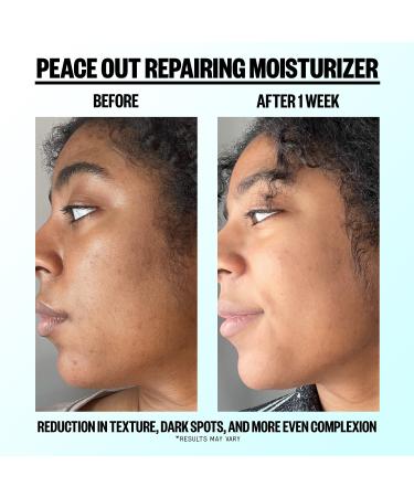 Shop Peace Out Daily Blemish Repairing Moisturizer - 1.7 oz/ 50 mL Online - Best Price & International Shipping - Buy Online on GoSupps.com