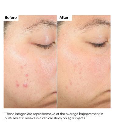 Shop The Ordinary Salicylic Acid 2% Exfoliating Blemish Solution - 1 oz / 30 mL Online - Best Price & International Shipping - Buy Online on GoSupps.com