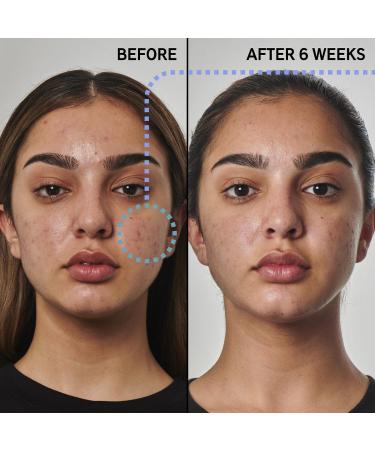 Shop The INKEY List SuperSolutions 5% Benzoyl Peroxide Cleanser Acne Solution - 5 oz / 150 mL Online - Best Price & International Shipping - Buy Online on GoSupps.com