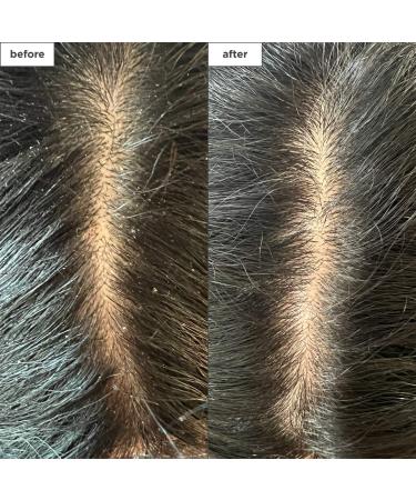 Shop Briogeo Scalp Revival Dandruff Relief Charcoal Shampoo - 8.4 oz/ 248 mL Online - Best Price & International Shipping - Buy Online on GoSupps.com