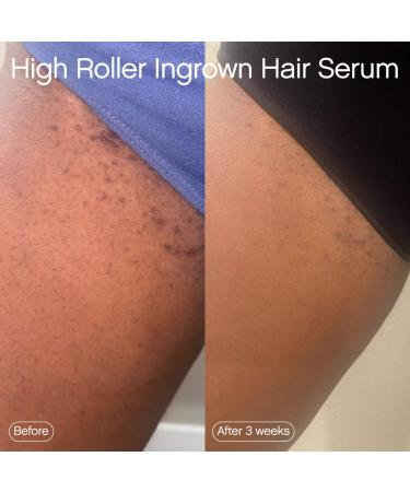 Shop Topicals High Roller Ingrown Hair Tonic with AHA and BHA - 1.7 oz/ 50 mL Online - Best Price & International Shipping - Buy Online on GoSupps.com