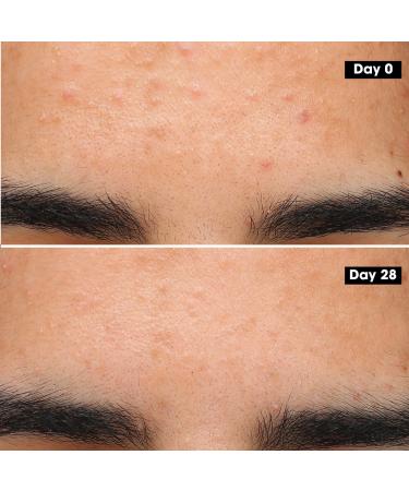 Shop SEPHORA COLLECTION Acne Treatment Gel - 1 oz / 30 mL Online - Best Price & International Shipping - Buy Online on GoSupps.com