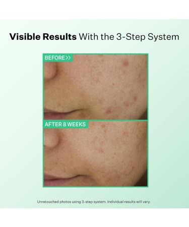 Shop StriVectin Multi Action Clear Acne Clearing Treatment Lotion for Breakouts - 1.7 oz / 50 mL Online - Best Price & International Shipping - Buy Online on GoSupps.com