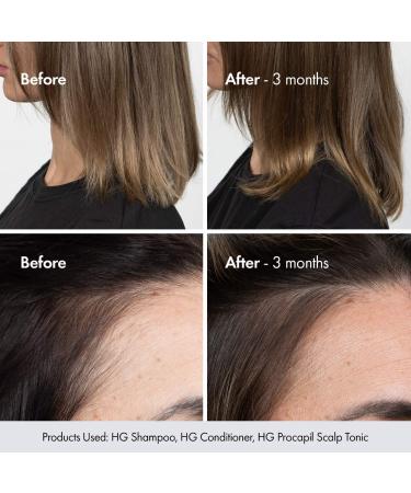 Shop BondiBoost HG Shampoo & Conditioner Set for Thinning Hair with Rosemary Online - Best Price & International Shipping - Buy Online on GoSupps.com
