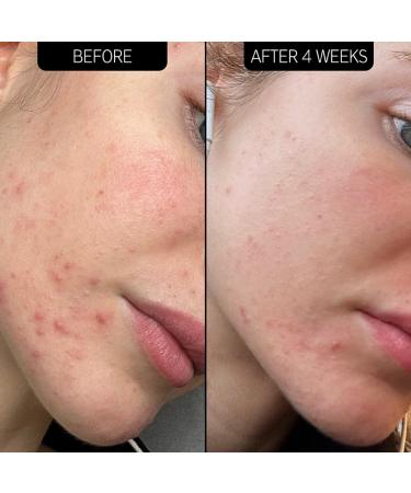 Shop The INKEY List SuperSolutions Acne Clearing Moisturizer 2% NOVORETIN - 1.7 oz / 50 ml Online - Best Price & International Shipping - Buy Online on GoSupps.com