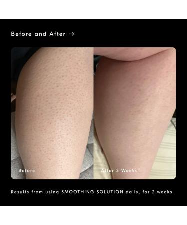 Shop Soft Services Smoothing Solution AHA Chemical Peel Body Exfoliator - 3.3 oz Online - Best Price & International Shipping - Buy Online on GoSupps.com