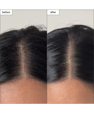 Shop Briogeo Scalp Revival Charcoal + Tea Tree Buildup Detox Spray - 4 oz / 120 ml Online - Best Price & International Shipping - Buy Online on GoSupps.com