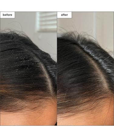 Shop Briogeo Scalp Revival Charcoal + Tea Tree Buildup Detox Spray - 4 oz / 120 ml Online - Best Price & International Shipping - Buy Online on GoSupps.com