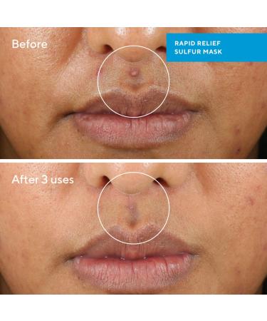 Shop Murad Rapid Relief Acne Sulfur Clay Mask with Salicylic Acid - 2.5 oz / 74 ml Online - Best Price & International Shipping - Buy Online on GoSupps.com