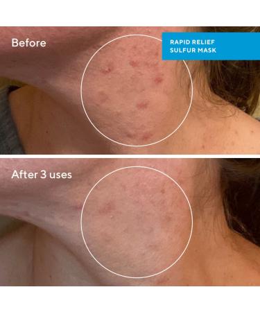 Shop Murad Rapid Relief Acne Sulfur Clay Mask with Salicylic Acid - 2.5 oz / 74 ml Online - Best Price & International Shipping - Buy Online on GoSupps.com