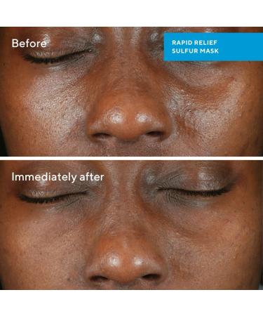 Shop Murad Rapid Relief Acne Sulfur Clay Mask with Salicylic Acid - 2.5 oz / 74 ml Online - Best Price & International Shipping - Buy Online on GoSupps.com