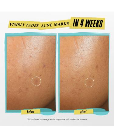 Shop Kiehl's Since 1851 Truly Targeted Acne-Clearing Pimple Patch with Salicylic Acid - Standard size Online - Best Price & International Shipping - Buy Online on GoSupps.com