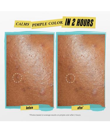 Shop Kiehl's Since 1851 Truly Targeted Acne-Clearing Pimple Patch with Salicylic Acid - Standard size Online - Best Price & International Shipping - Buy Online on GoSupps.com