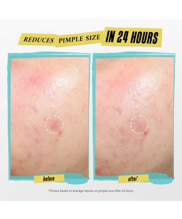 Shop Kiehl's Since 1851 Truly Targeted Acne-Clearing Pimple Patch with Salicylic Acid - Standard size Online - Best Price & International Shipping - Buy Online on GoSupps.com