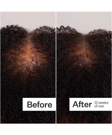 Shop Act+Acre 0.25mm Scalp Dermaroller for Thicker + Fuller Looking Hair - Standard size Online - Best Price & International Shipping - Buy Online on GoSupps.com