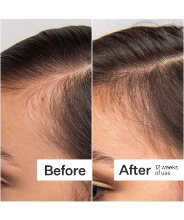 Shop Act+Acre 0.25mm Scalp Dermaroller for Thicker + Fuller Looking Hair - Standard size Online - Best Price & International Shipping - Buy Online on GoSupps.com