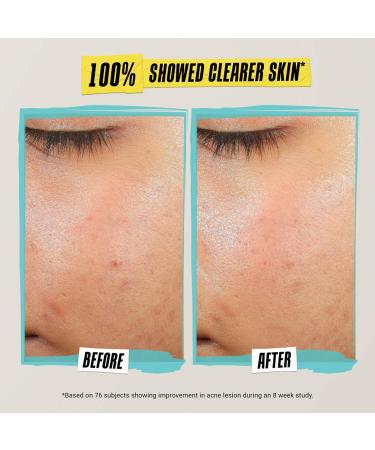 Shop Kiehl's Since 1851 Expertly Clear Moisturizer for Acne Prone Skin with Salicylic Acid - 2 oz Online - Best Price & International Shipping - Buy Online on GoSupps.com