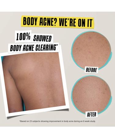 Shop Kiehl's Since 1851 Expertly Clear Moisturizer for Acne Prone Skin with Salicylic Acid - 2 oz Online - Best Price & International Shipping - Buy Online on GoSupps.com