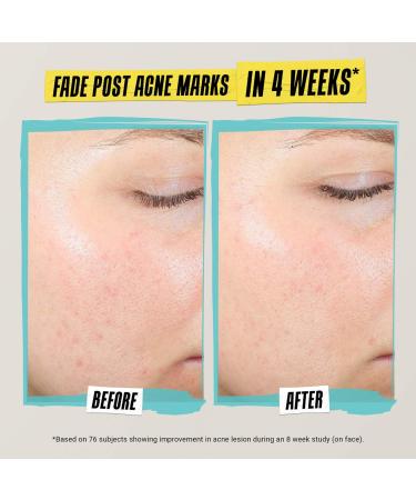 Shop Kiehl's Since 1851 Expertly Clear Moisturizer for Acne Prone Skin with Salicylic Acid - 2 oz Online - Best Price & International Shipping - Buy Online on GoSupps.com