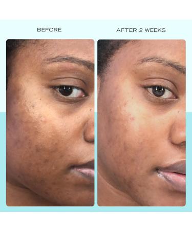 Shop First Aid Beauty Dark Spot Serum with Niacinamide - 1 oz Online - Best Price & International Shipping - Buy Online on GoSupps.com