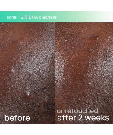 Shop Skinfix acne+ triple threat set with Salicylic Acid (BHA) + Niacinamide with B-L3 Online - Best Price & International Shipping - Buy Online on GoSupps.com