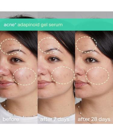 Shop Skinfix acne+ triple threat set with Salicylic Acid (BHA) + Niacinamide with B-L3 Online - Best Price & International Shipping - Buy Online on GoSupps.com