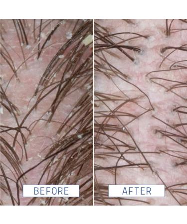 Shop AAVRANI Anti-Dandruff Scalp Serum with Salicylic Acid For Congested + Flaky Scalp - 2 oz Online - Best Price & International Shipping - Buy Online on GoSupps.com