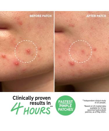 Shop The INKEY List Hydrocolloid Invisible Pimple Patches + Salicylic Acid Online - Best Price & International Shipping - Buy Online on GoSupps.com