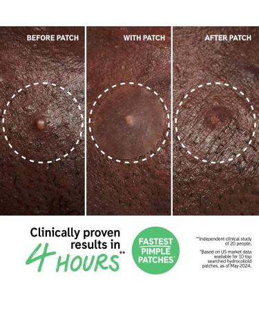 Shop The INKEY List Hydrocolloid Invisible Pimple Patches + Salicylic Acid Online - Best Price & International Shipping - Buy Online on GoSupps.com