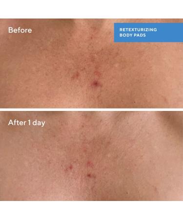 Shop Murad Retexturizing Body Pads with Salicylic Acid - 45 pads / pack Online - Best Price & International Shipping - Buy Online on GoSupps.com