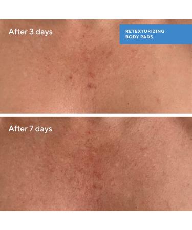 Shop Murad Retexturizing Body Pads with Salicylic Acid - 45 pads / pack Online - Best Price & International Shipping - Buy Online on GoSupps.com