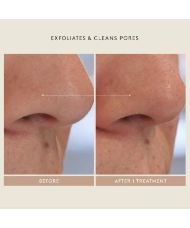 Shop Shani Darden Skin Care Mini Triple Acid Signature Peel - Mini size Online - Best Price & International Shipping - Buy Online on GoSupps.com