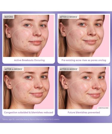 Shop Glow Recipe Blackberry Retinol Blemish Serum - 1 oz / 30 ml Online - Best Price & International Shipping - Buy Online on GoSupps.com