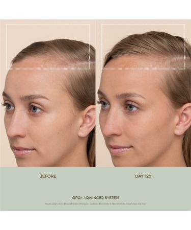 Shop Vegamour GRO+ Advanced Hair Serum for Severe Signs of Thinning - 1 fl oz / 30 mL Online - Best Price & International Shipping - Buy Online on GoSupps.com
