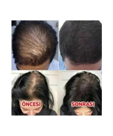 Purexpose Hair Growth Helping Yellow Serum - Strengthens Nourishes Hair 1 Serum 1dermaroller - Buy Online on GoSupps.com
