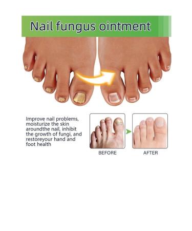 roc rochers Effective Herbal Content & Nail Mycosis Solution Toenail Fungus Treatment Repair - Buy Online on GoSupps.com