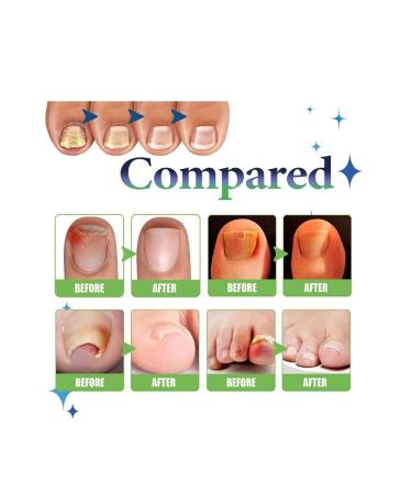 roc rochers Effective Herbal Content & Nail Mycosis Solution Toenail Fungus Treatment Repair - Buy Online on GoSupps.com