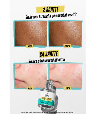 Kiehl's Anti-Acne Redness and Acne Scar Reducing Serum 15 ml - Buy Online on GoSupps.com