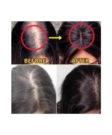 Purexpose Hair Growth Repairing Visualizer 10pcs Serum1 Dermaroller - Buy Online on GoSupps.com