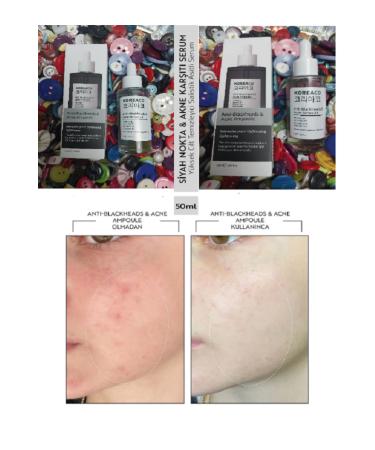 KOREACO ANTI-BLACK SPOTS AND ANTI-ACNE HIGH SKIN CLEANSING SERUM 50 ML - Buy Online on GoSupps.com