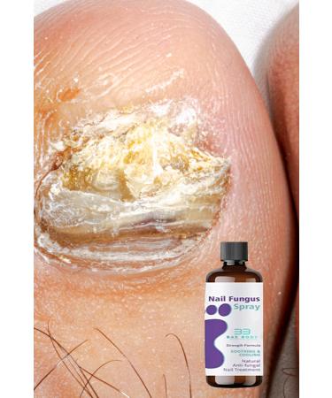 baebody Eliminator & Deep Treatment & Advanced Antifungal Serum & Large Size