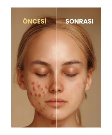 ALUULA Zawira No More Acne: Powerful Anti-Acne Serum (30 ML) - Buy Online on GoSupps.com