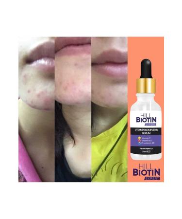 HILL BIOTIN EXPERT Vitamin C Anti-Spot & Brightening Acne Anti-Wrinkle Serum 30ml - Buy Online on GoSupps.com